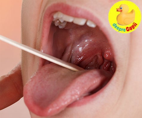 Amigdalita (Tonsilita) la copil -  cauze si tratament