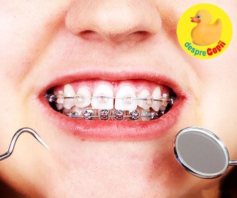 De ce trebuie purtat aparatul dentar in copilarie -  motive si beneficii