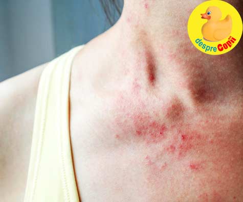 Anumite alimente sunt cauza ascunsa a eczemelor - iata sfatul medicului dermatolog