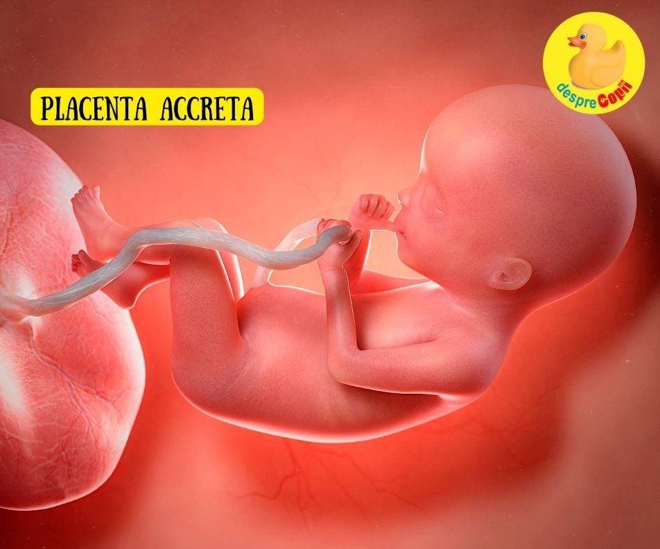 Placenta accreta -  cauze, prevenire si tratament - sfatul medicului ginecolog