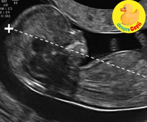 Prima morfologie de sarcina -  emotii ca la un examen - jurnal de sarcina