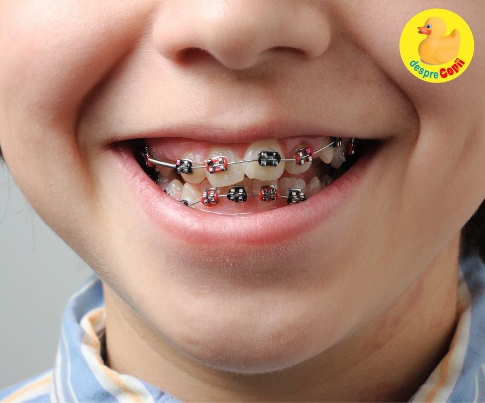 Semne care indica necesitatea unui aparat dentar pentru copii