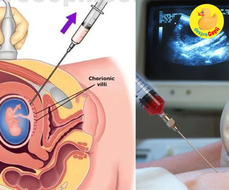 Testul de vilus corionic sau prelevarea de vilozitati coriale - cand si de ce se efectueaza in timpul sarcinii