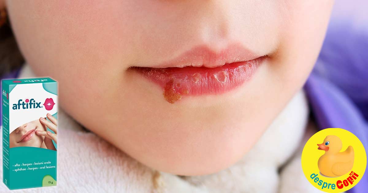 Cele mai frecvente afectiuni orale la copil -  aftele si herpesul. Cum putem ajuta copilul?