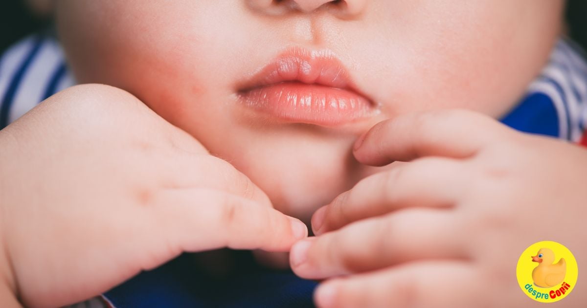 Cum tratam buzele uscate si crapate ale bebelusului si ce pot semnala sfatul medicului