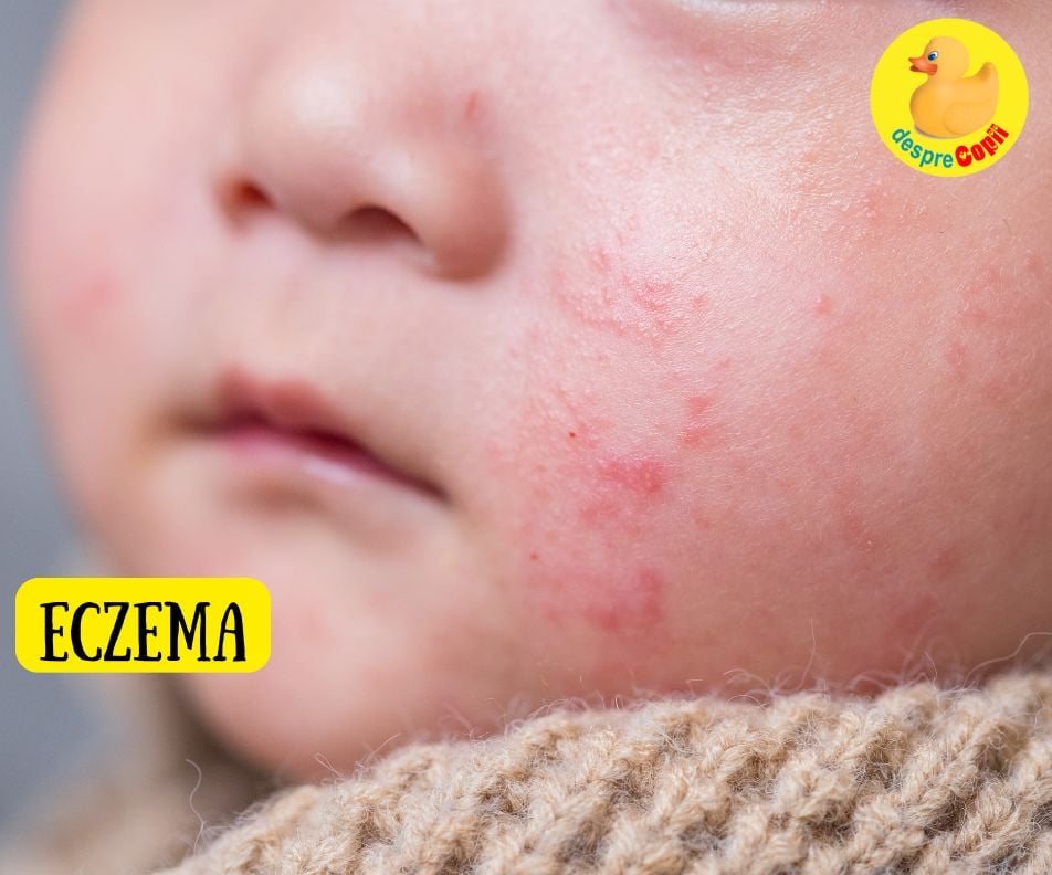 Eczema la copil. Legatura cu alergiile si cum se trateaza - sfatul medicului dermatolog