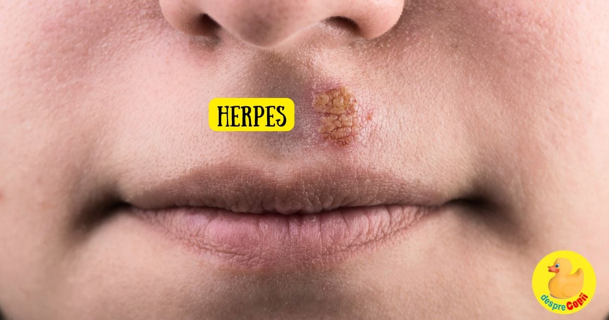 Infectia cu herpes simplex la copii - 6 intrebari si raspunsuri de la medic