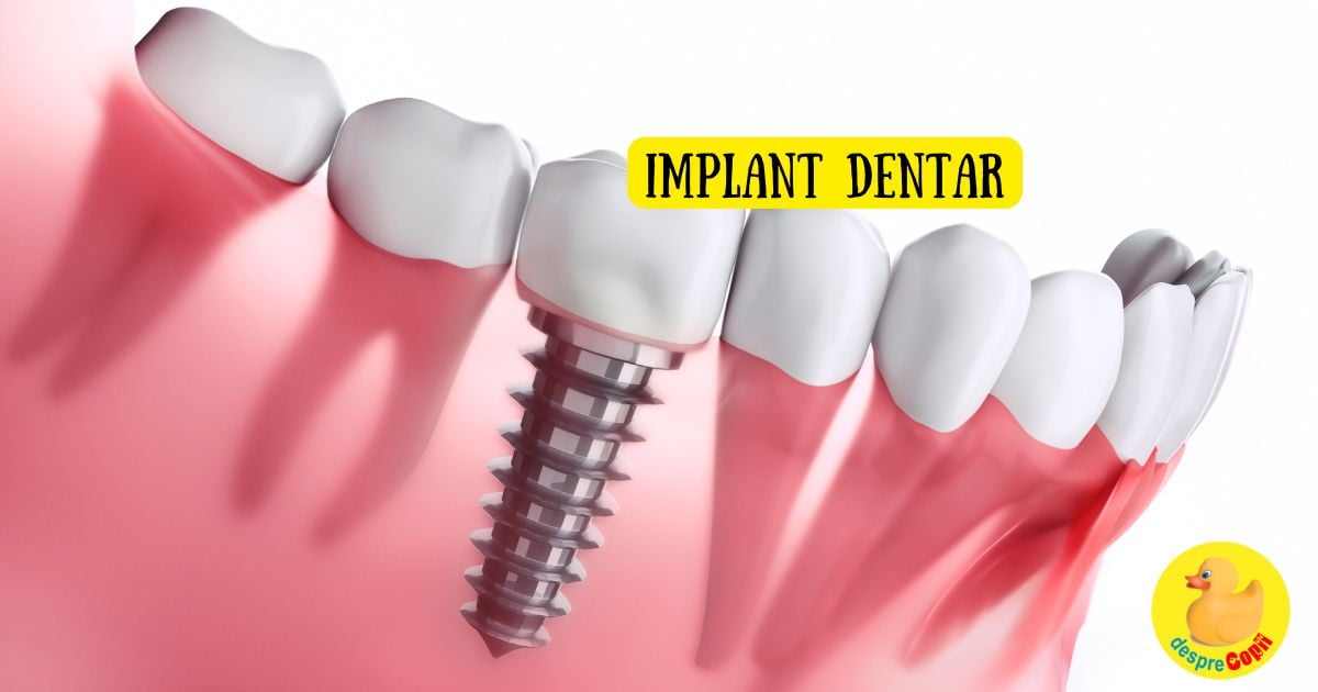 6 lucruri esentiale despre implanturile dentare care iti pot transforma zambetul