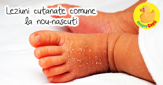 Leziuni cutanate comune la nou-nascuti -  despre pielea bebelusilor - sfatul medicului