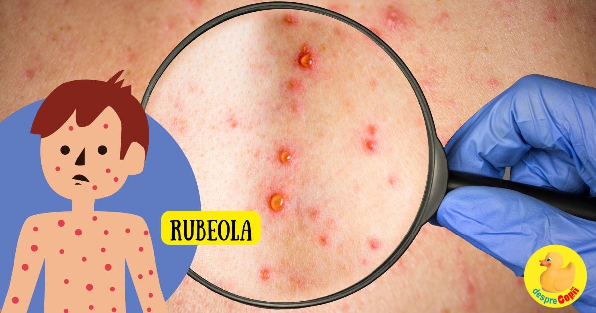 Rubeola la copil - simptome, tratament si prevenire