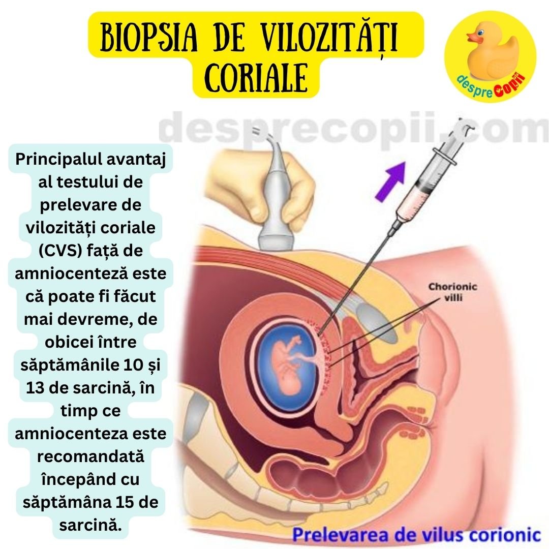 Testul de vilus corionic (sau biopsia de vilozități coriale)