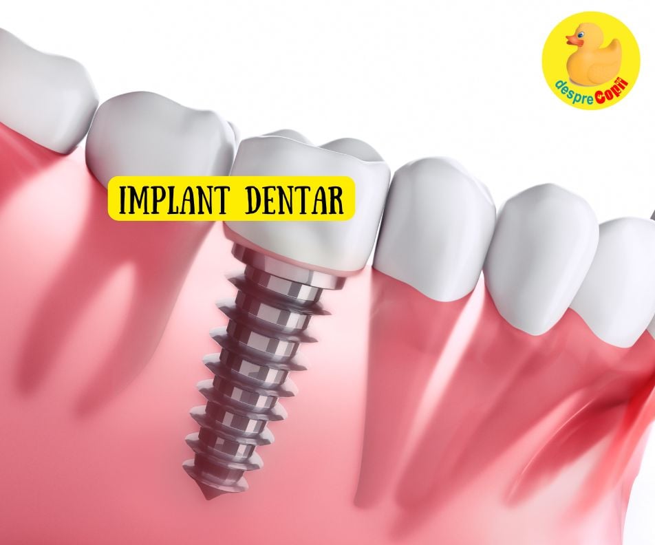 6 lucruri esentiale despre implanturile dentare care iti pot transforma zambetul