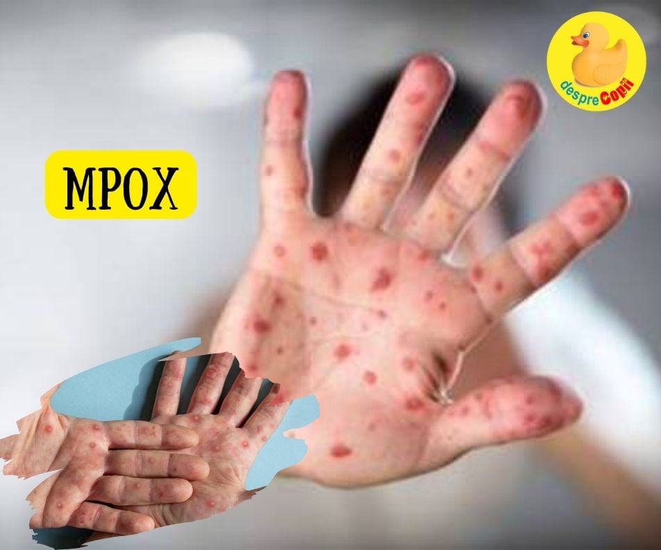 Boala MPOX - cum se transmite si cum poate fi prevenita