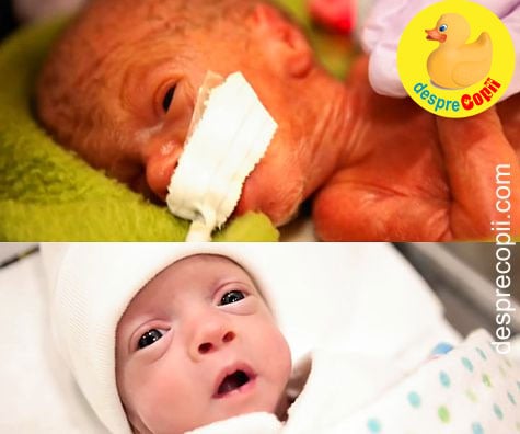 Primele zile de viață ale unui bebeluș prematur născut la 26 de săptămani