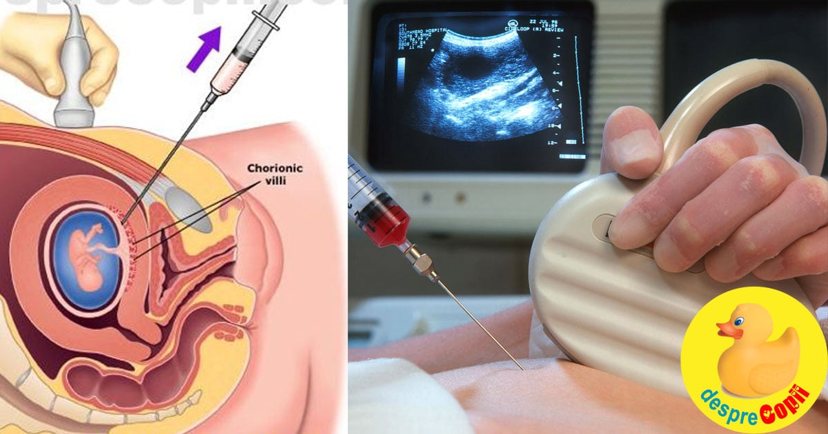 Testul de vilus corionic sau prelevarea de vilozitati coriale - cand si de ce se efectueaza in timpul sarcinii width=